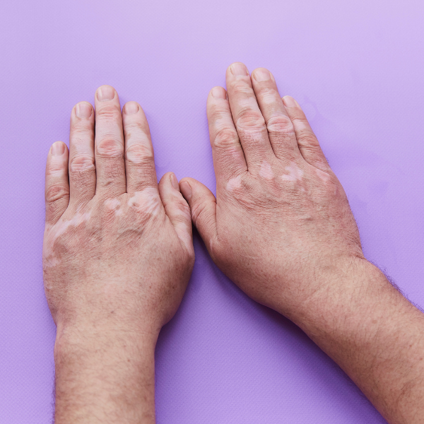 Pigmentation
